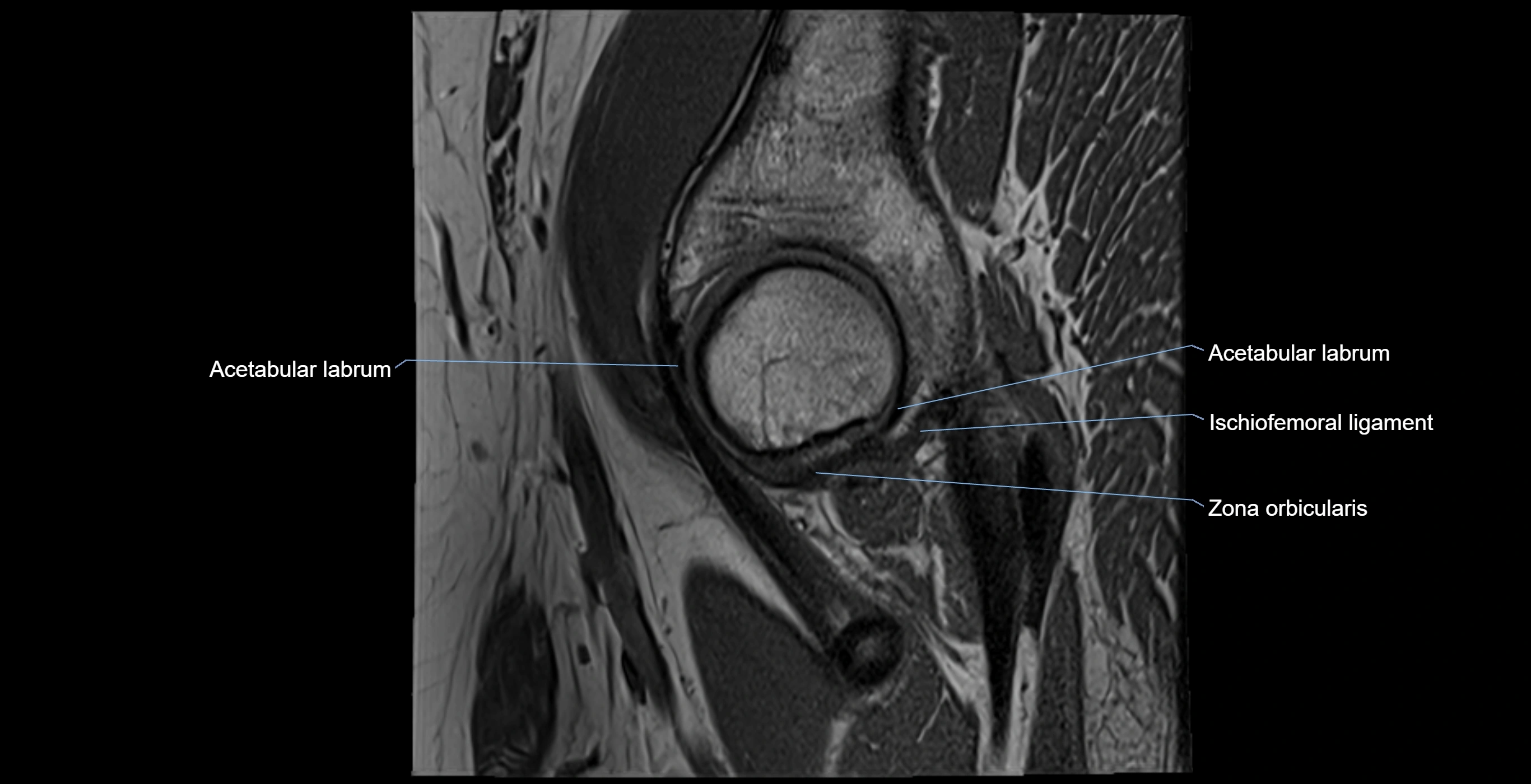 MRI Hip ligaments sagittal cross sectional anatomy 3T  radiology  image-img-00001-00007.webp